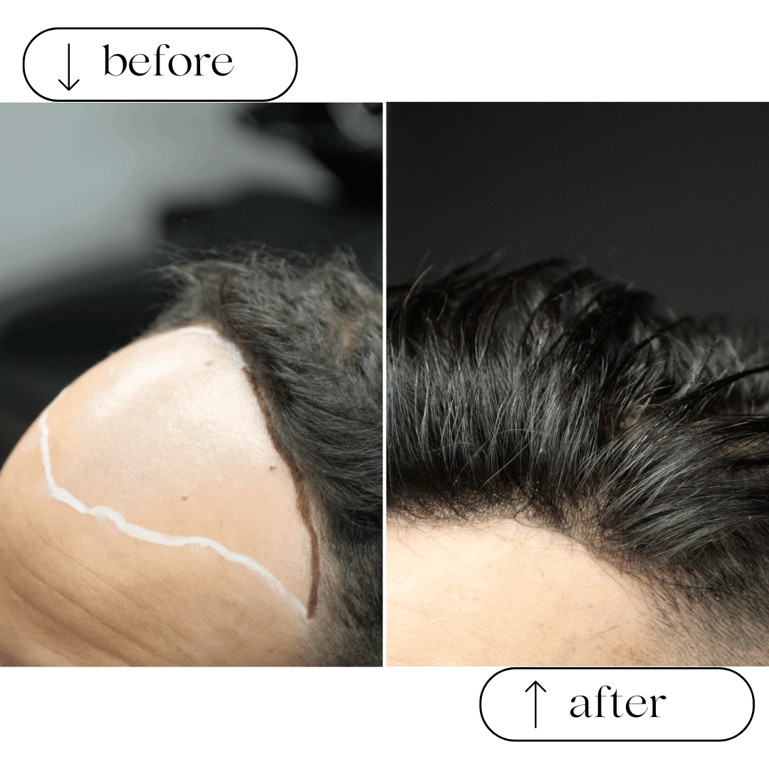 Soluzioni per calvizie e alopecia - calvizia 