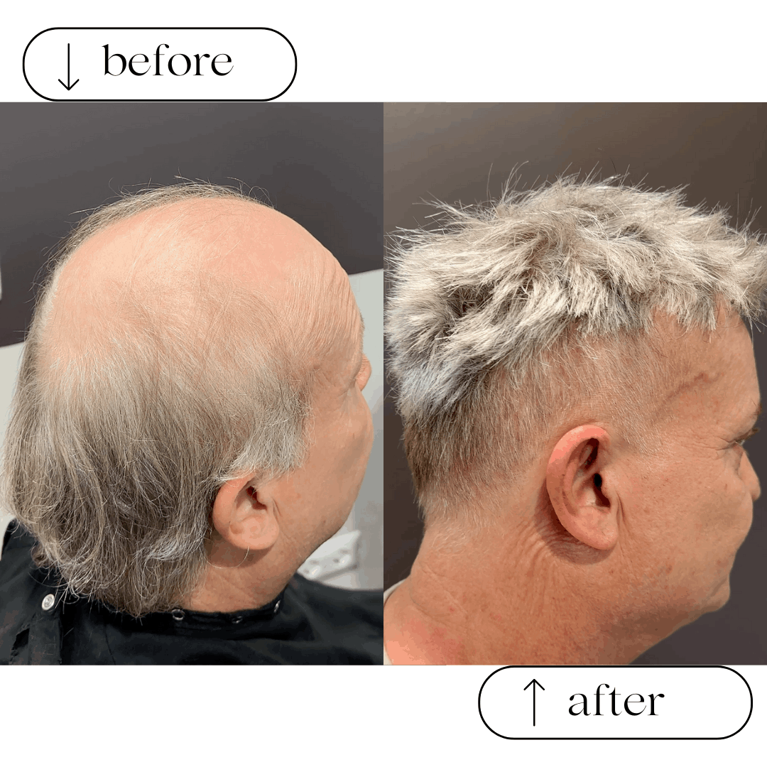 Soluzioni per calvizie e alopecia - calvizia 