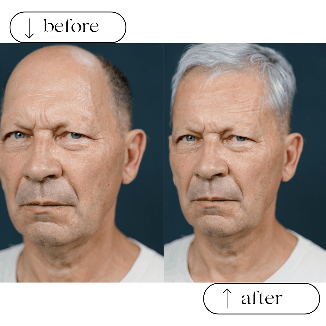 Soluzioni per calvizie e alopecia - calvizia 