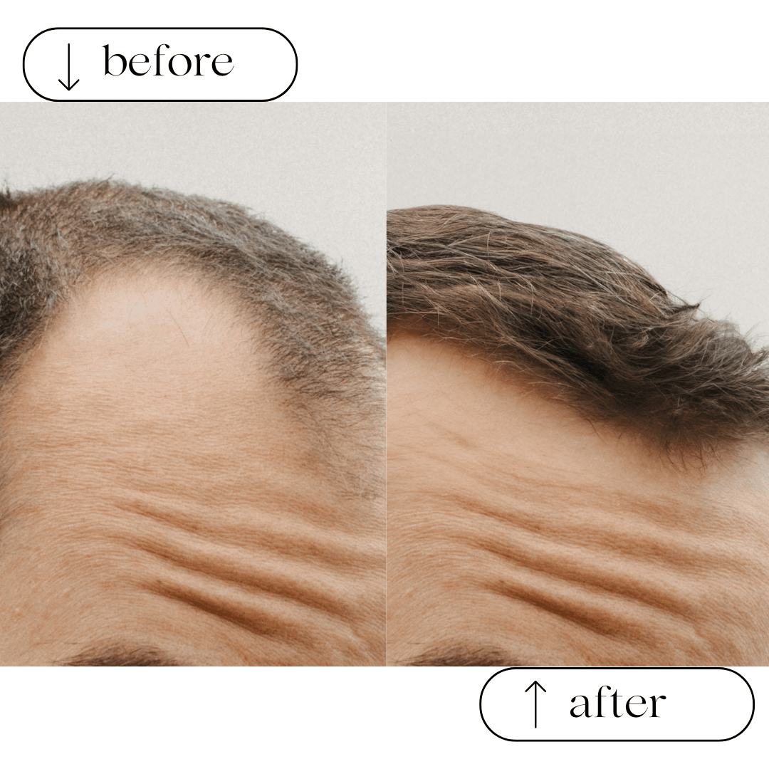 Soluzioni per calvizie e alopecia - calvizia 