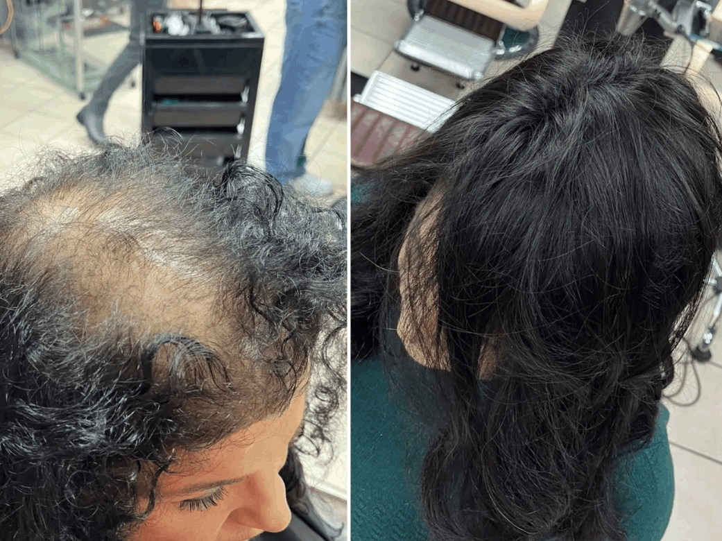 Soluzioni per calvizie e alopecia - Consulenza Soluzioni Alopecia Uomo Trofarello