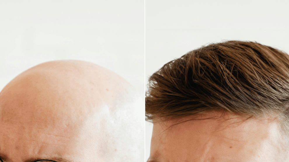 Soluzioni per calvizie e alopecia - Consulenza Soluzioni Alopecia Uomo Trofarello