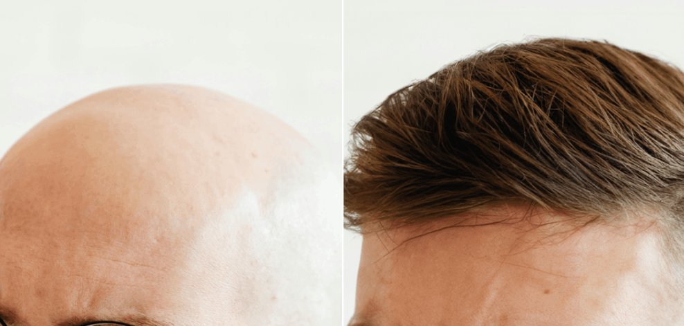 Soluzioni per calvizie e alopecia -  Soluzioni Perdita Capelli Trofarello